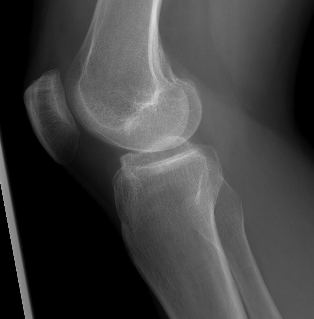 Acl Avulsion Fracture 