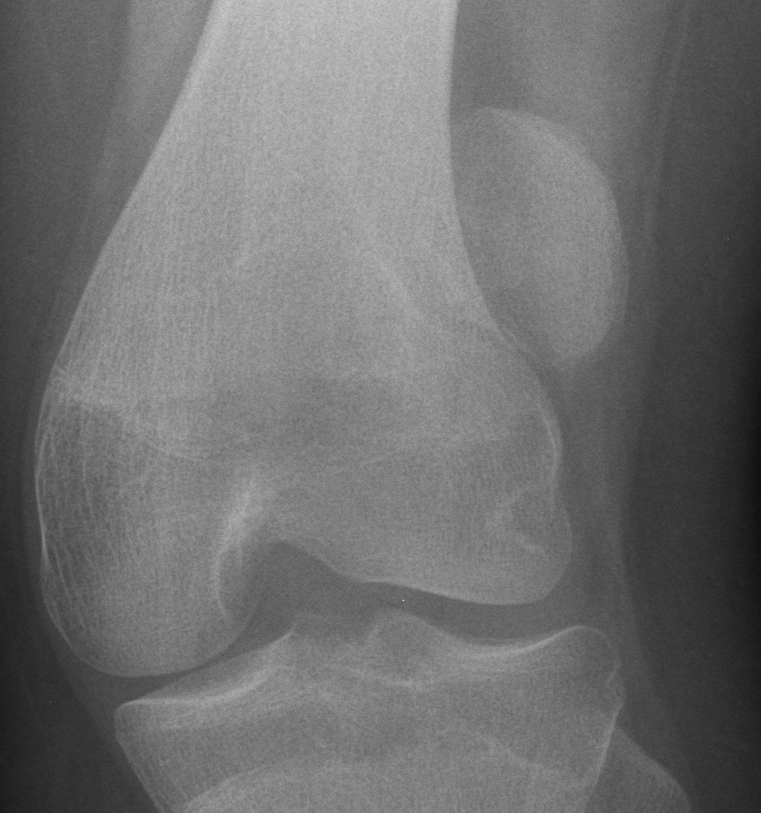 x ray of dislocated knee