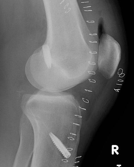 Lars Pcl Reconstruction Technique The Bone School