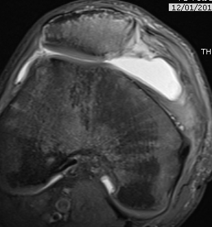 patellar subluxation mri