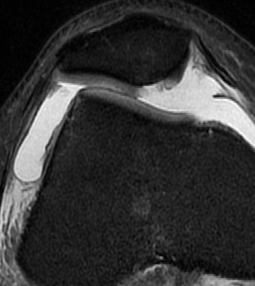 patellar subluxation mri