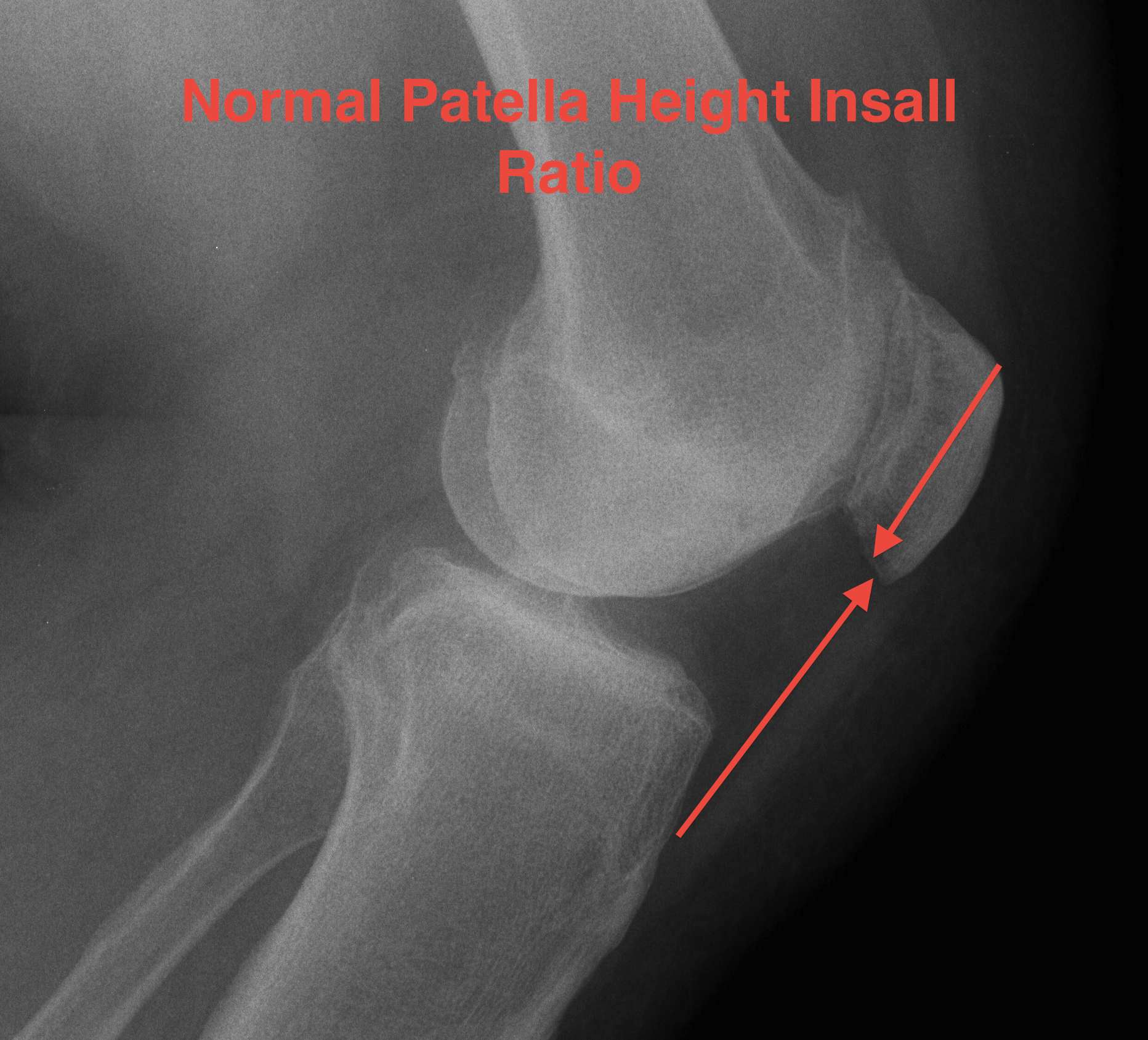 patellar dislocation xray