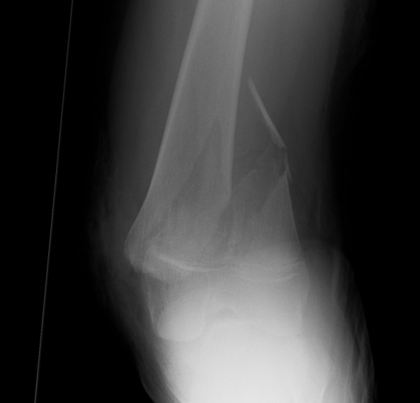 Distal Femoral Physeal Injuries 