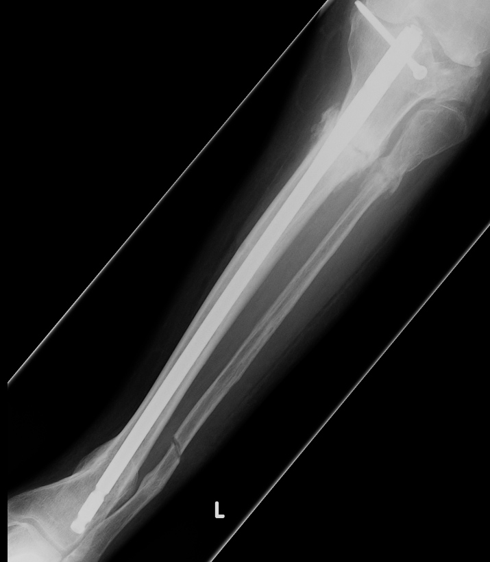 Mechanical Lateral Distal Femoral Angle 