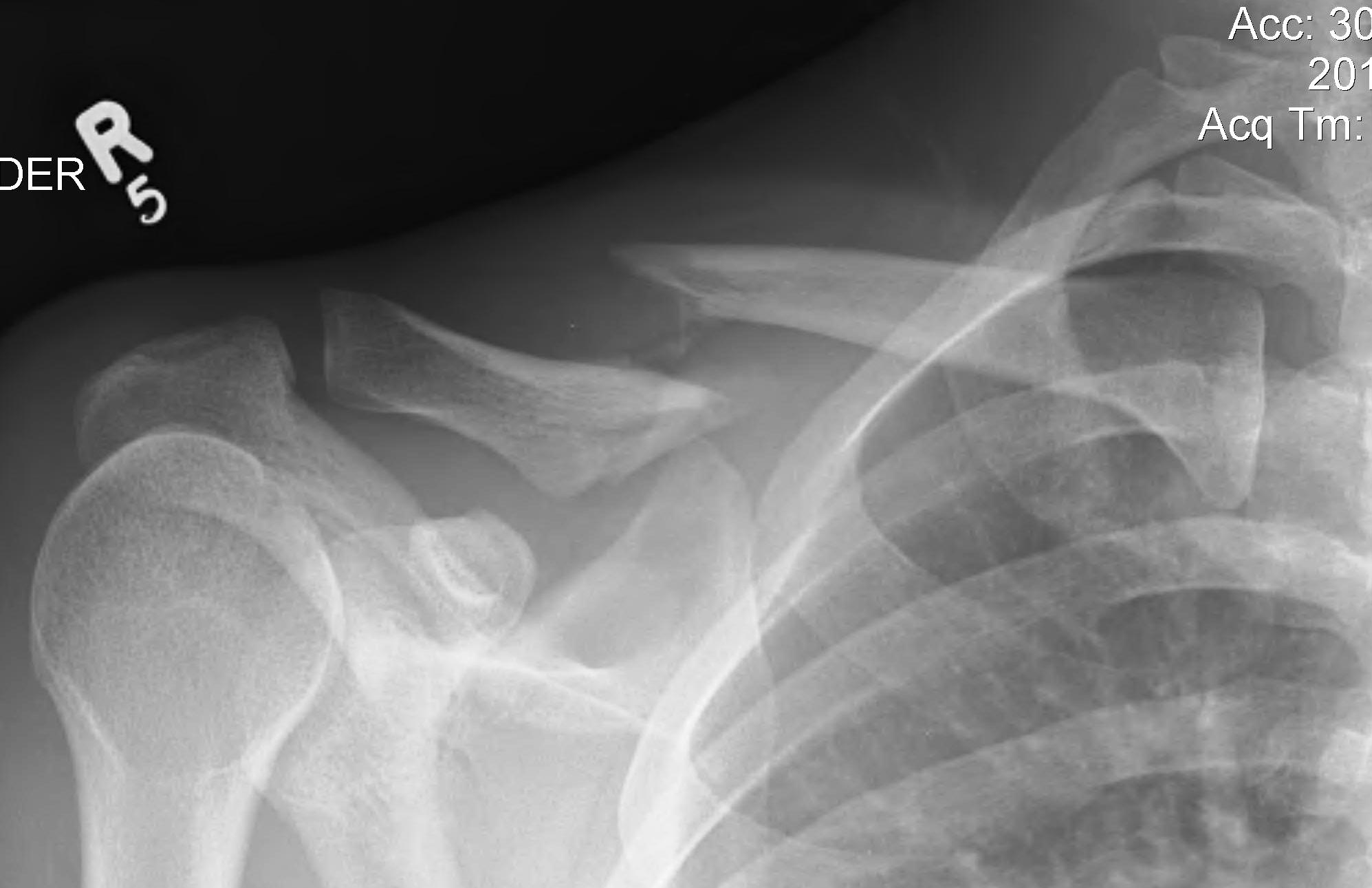 clavicle fracture