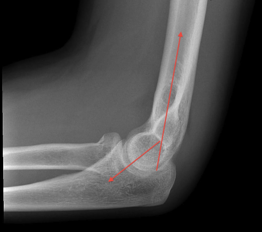 comminuted intra articular fracture distal humerus