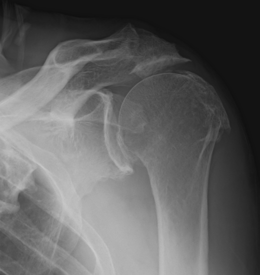 rotator cuff arthropathy