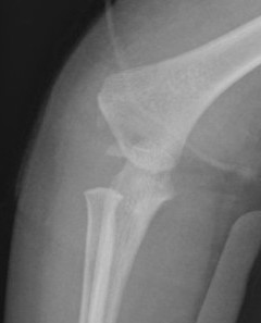 Distal physeal