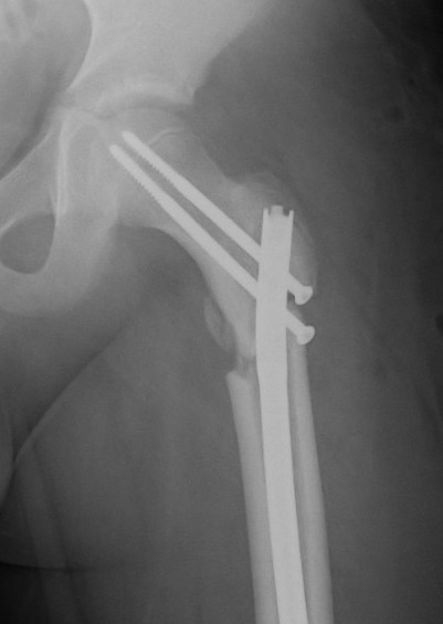 fracture
