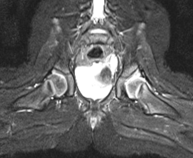 MRI