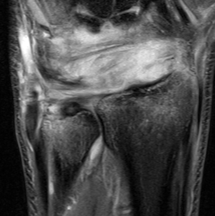 ulna styloid