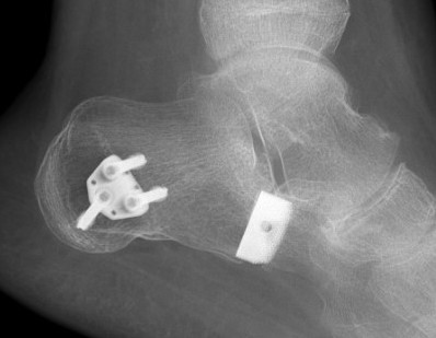 C lengthening