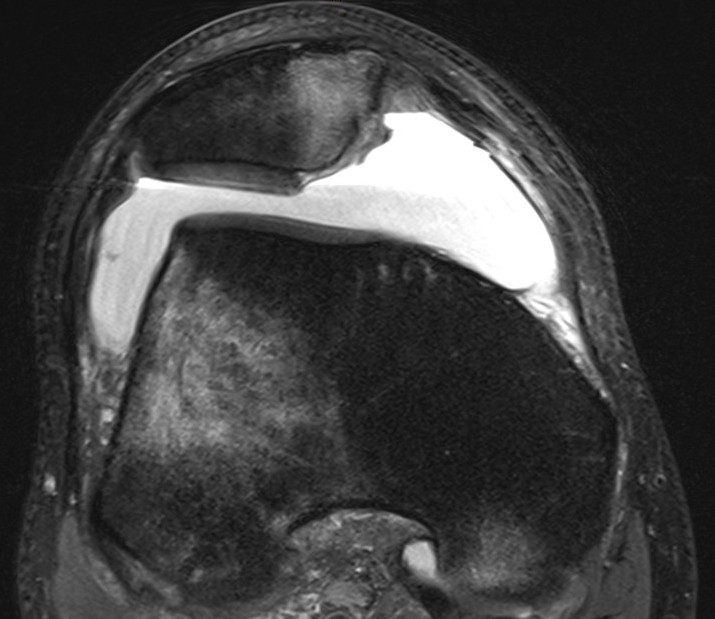 Patella