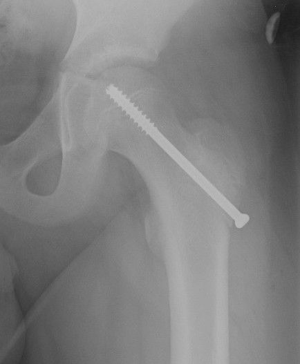 fracture