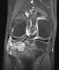 Chondroblastoma MRI