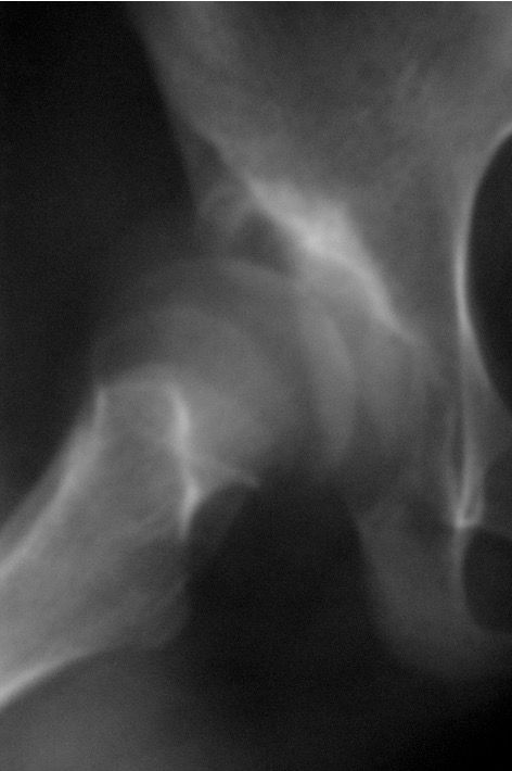 Chiari