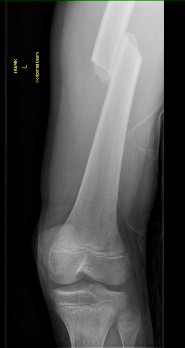 Femur