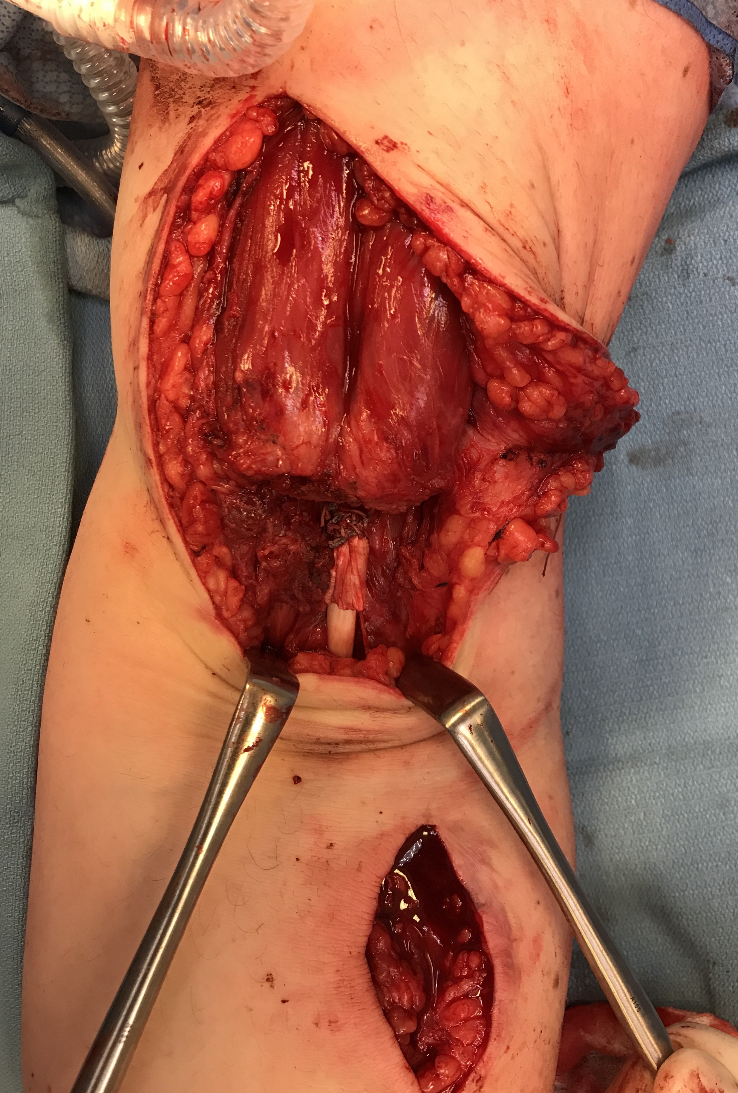 Two incision allograft reconstruction