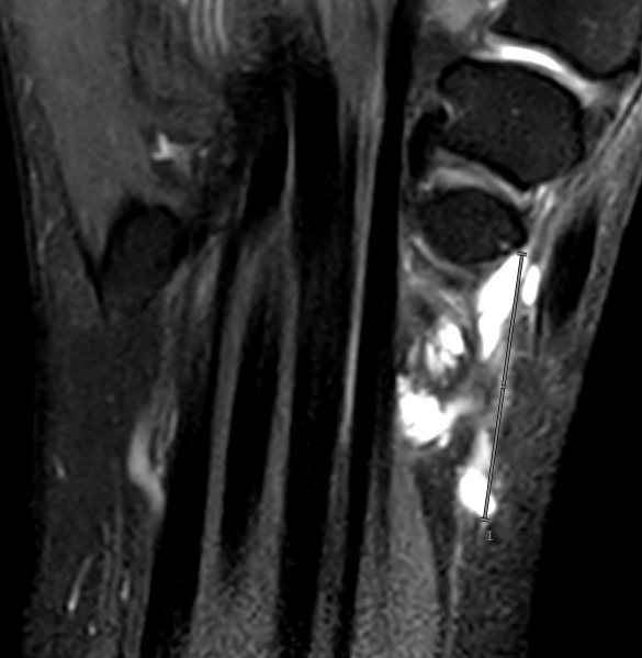 volar ganglion