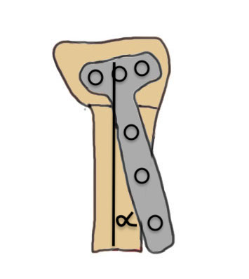 volar osteotomy