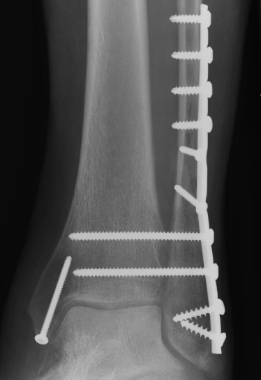 Fibular fracture