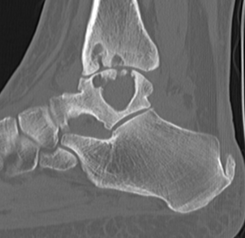 Ankle PVNS CT