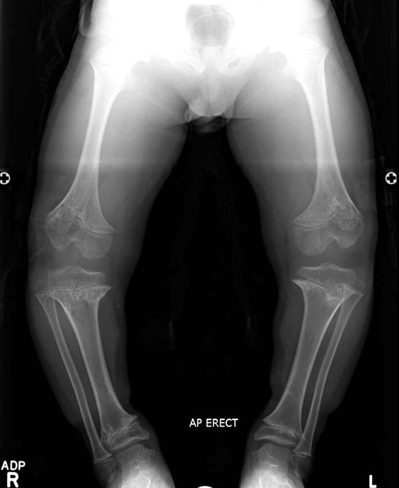achondroplasia