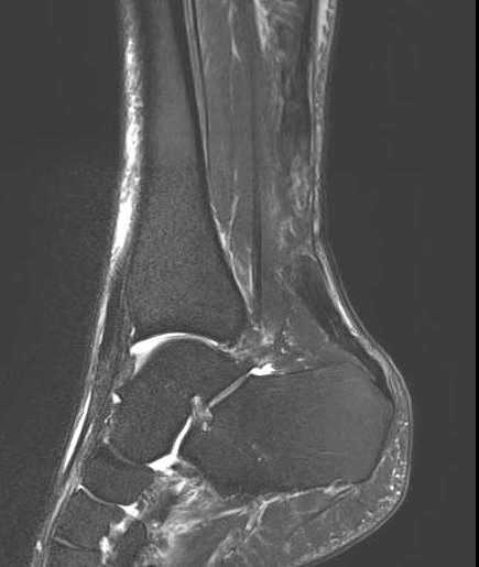 Acute achilles tendon tear