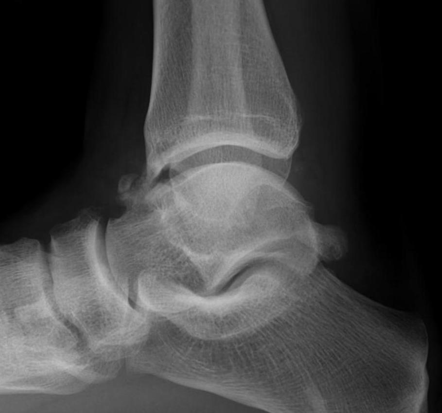 Anterior ankle spur