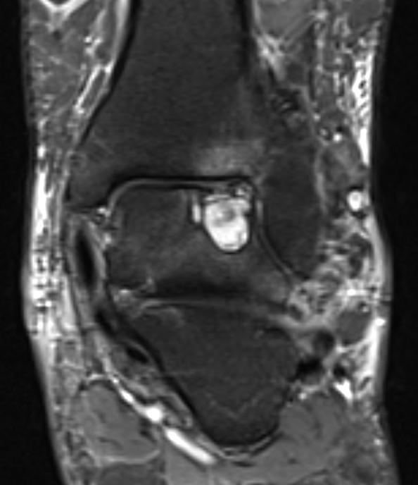 Ankle PVNS MRI 2