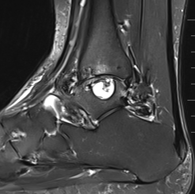Ankle PVNS MRI