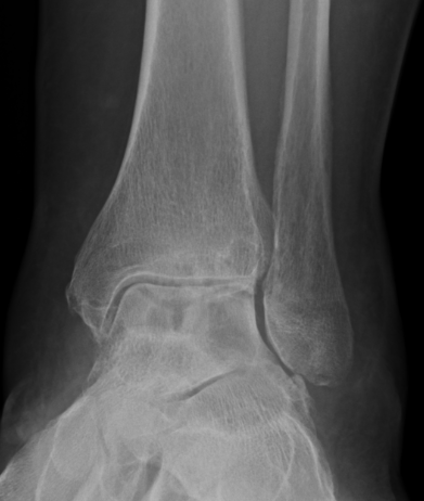 Ankle PVNS 1