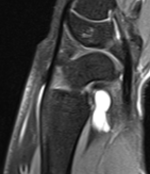 ganglion