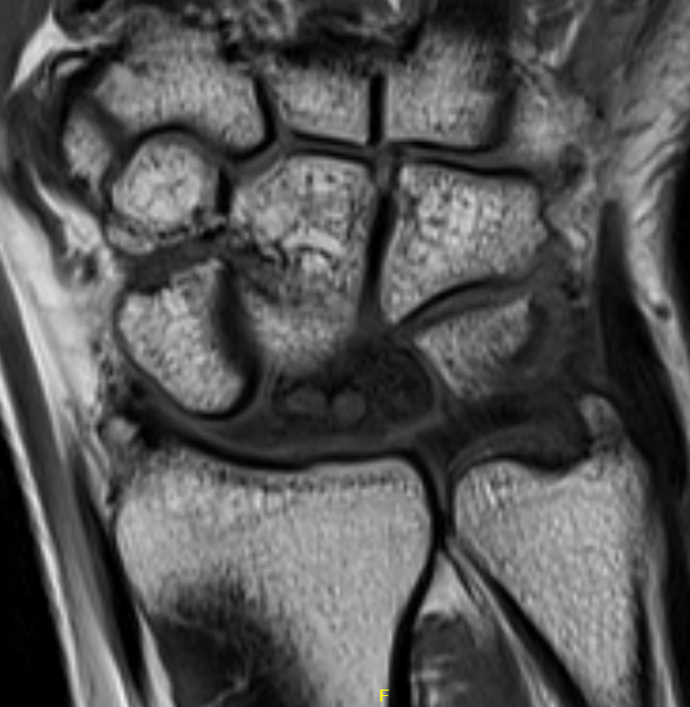MRI kien