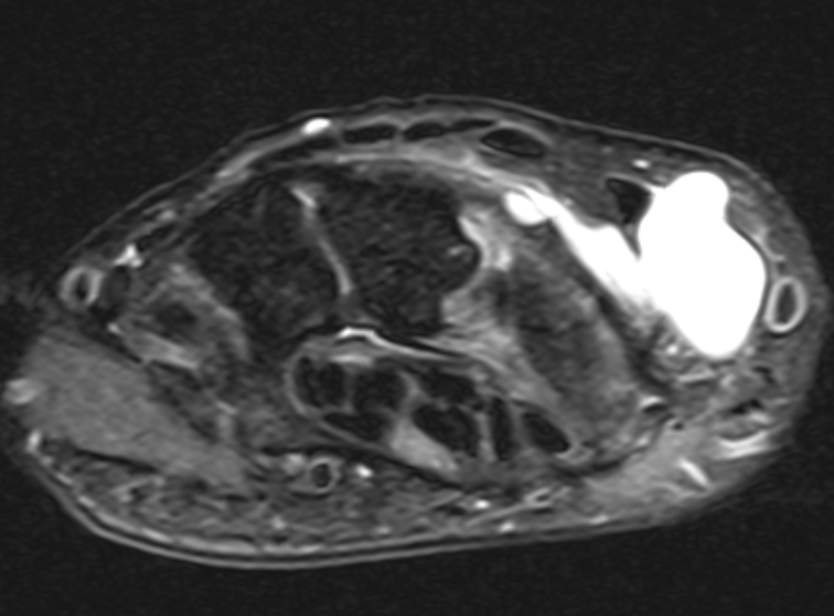 ganglion