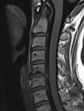 Cx spondylosis MRI