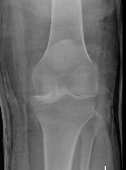 Anterior knee dislocation 2