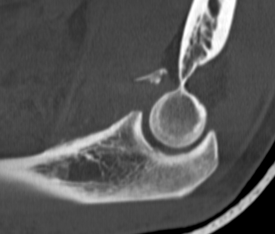 coronoid