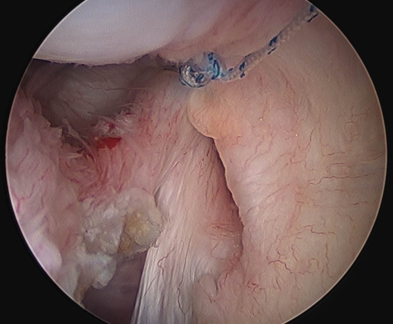Capsular repair