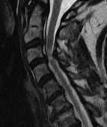 MRI cord damage stenosis