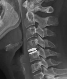 Cervical disc replacement 2