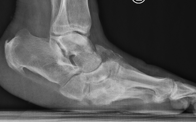 Charcot
