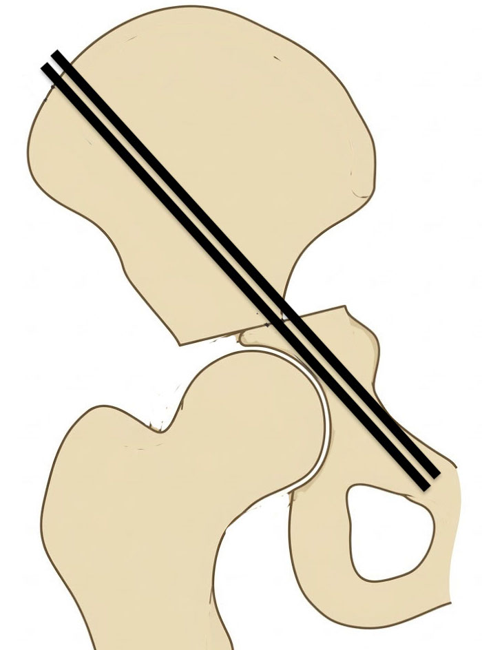 Chiari
