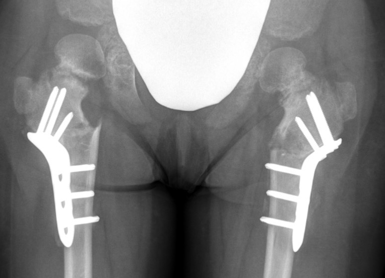 Valgus