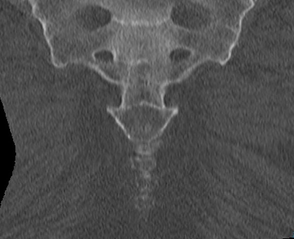 Coccyx CT 1