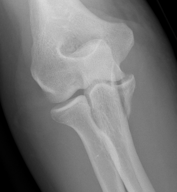 coronoid