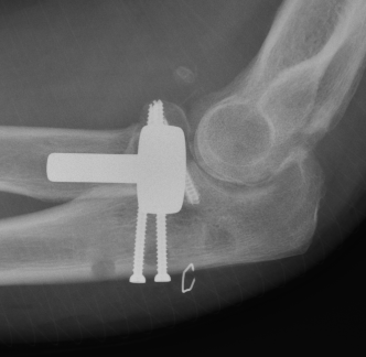coronoid