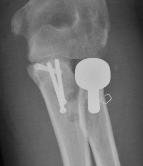coronoid process