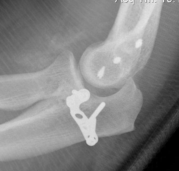 coronoid