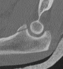 coronoid
